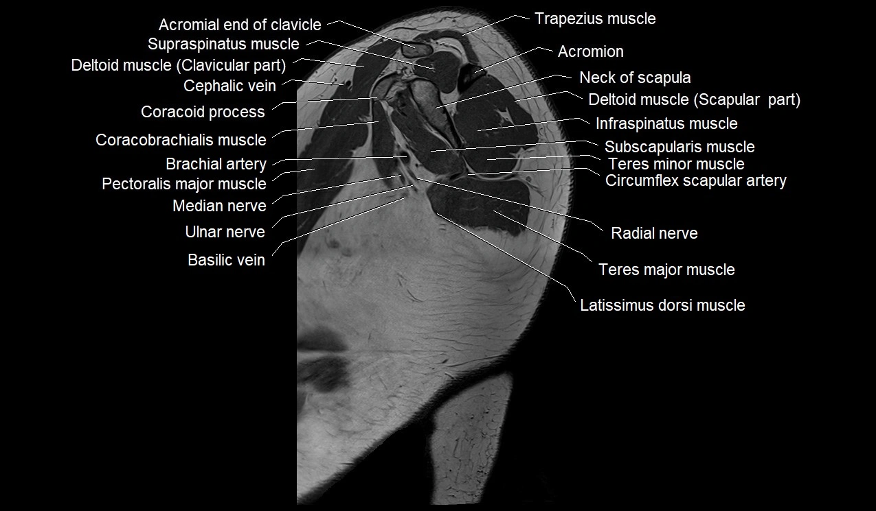 Upper arm (humerus ) saittal cross sectional anatomy 3T image 30.webp